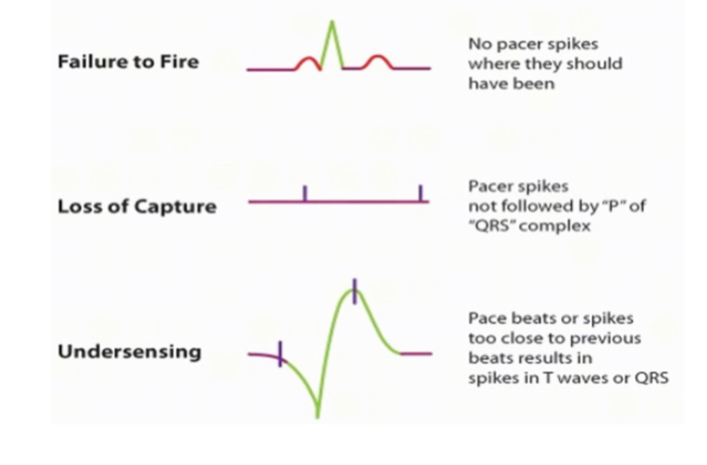 <p>Failure to fire</p><p>Loss of capture</p><p>Undersensing</p>