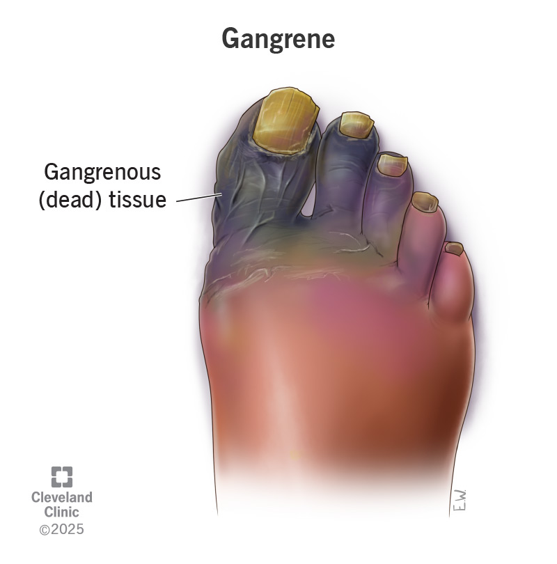 <p>Gas gangrene</p>