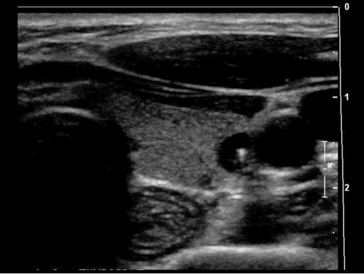 <p>Find the longus colli muscle</p>