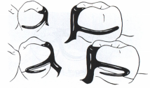 <p>This type of Circumferential Clasp/ Suprabuldge clasp is called</p>