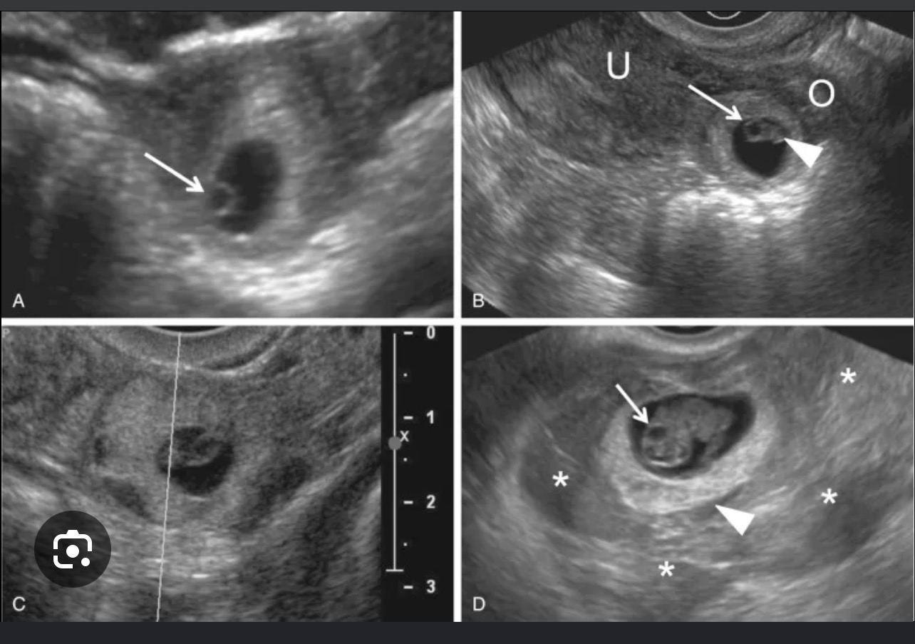 <p>Unilateral mass</p><p>Extrauterine gestational sac with/ wO live embryo(bagel’s sign)</p><p>•Fluid in the pouch of Douglas</p><p>•Absence of a well-defined gestation sac/fetus in the uterus.</p><p>•Presence of fetal cardiac</p>