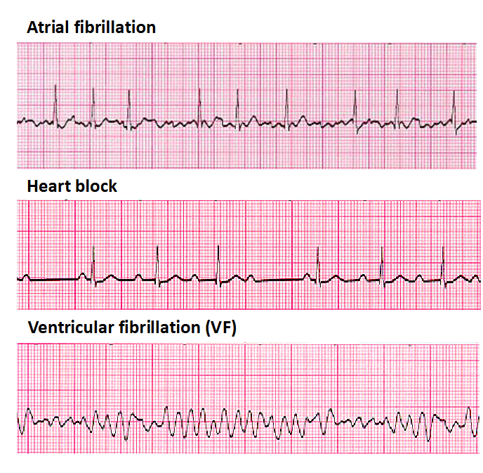 <p><span>Many sites within the atria</span><br><span>are generating their own</span><br><span>electrical impulses, leading</span><br><span>to irregular conduction of</span><br><span>impulses to the ventricles</span><br><span>that generate the heartbeat</span></p><p><span>Not all atrial beats getting</span><br><span>through to the ventricles</span></p><p><span>Disorganized electrical</span><br><span>signals: ventricles quiver</span><br><span>instead of contract. Patient</span><br><span>unconscious as blood is not</span><br><span>pumped to the brain.</span><br><span>Immediate defibrillation is</span><br><span>indicated. May occur in MI.</span></p>