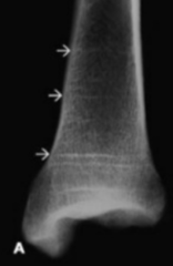 <p>lines of interrupted growth or Harris lines.</p><p>. Note the appearance of these lines extending into the metaphyses of the long bones</p>