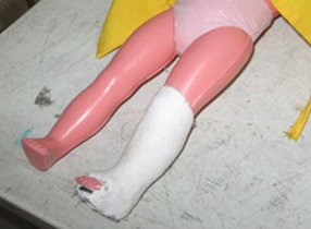 <p><span>tibia fibula with callus formation</span></p>