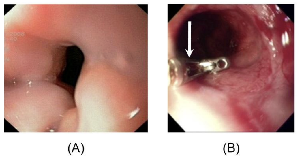 <p>normal (A), diagnosis in (B)</p>