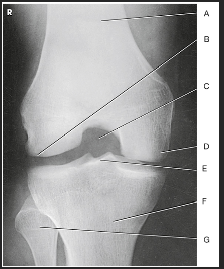 <p>How do you know this image is a Beclere Method</p>