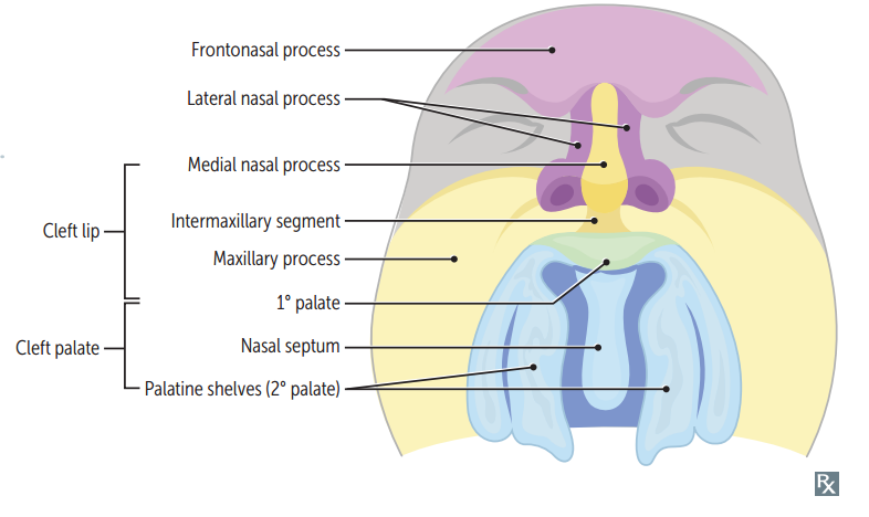 Failure of fusion of the 2 lateral palatine shelves OR failure of a lateral palatine shelf to fuse with the nasal septum and/or primary palate → defective formation of the secondary palate