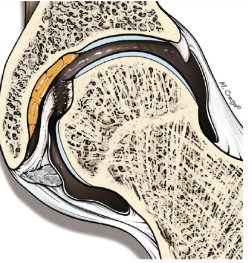 <p>What condition of the ligamentum teres is shown</p>
