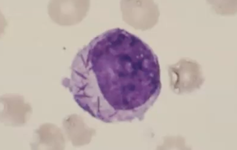 <p>promyelocyte w/ bundle of auer rods </p>