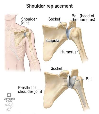 <ol><li><p>surgical resection of arthritic bone of humerus</p></li><li><p>replaces articular portion of head with metal ball</p></li><li><p>stem of metal ball inserted into shaft of humerus</p></li><li><p>prosthesis inserted into glenoid fossa of scapula→creates new socket for new head of humerus to articulate with</p></li></ol><p></p>