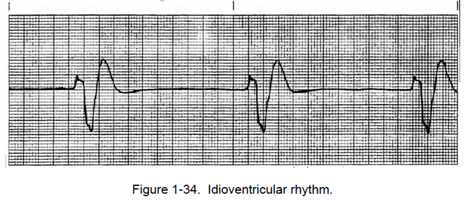 <p>Rate: 20-40</p><p>Regularity: regular </p><p>QRS > 0.12</p>