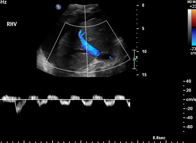 <p>Imaging of hepatic veins. What are the findings and suspected diagnoses.</p>