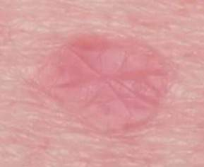 <p><span>______ appears as a pink to brown papule or plaque. It may mimic non-melanoma skin cancer (NMSC), such as BCC, and typically occurs on actinically damaged skin</span></p>