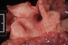 <p>The intima of the pulmonary artery has a shaggy and roughened appearance. What is the name of this lesion?</p><p>A) Arteritis </p><p>B) Aneurysm </p><p>C) Atherosclerosis </p><p>D) Fibroelastosis</p>