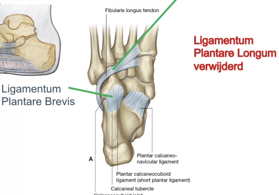 <ul><li><p>lig plantare brevis</p></li><li><p>Plantair calcaneonaviculair lig</p></li></ul><p></p>