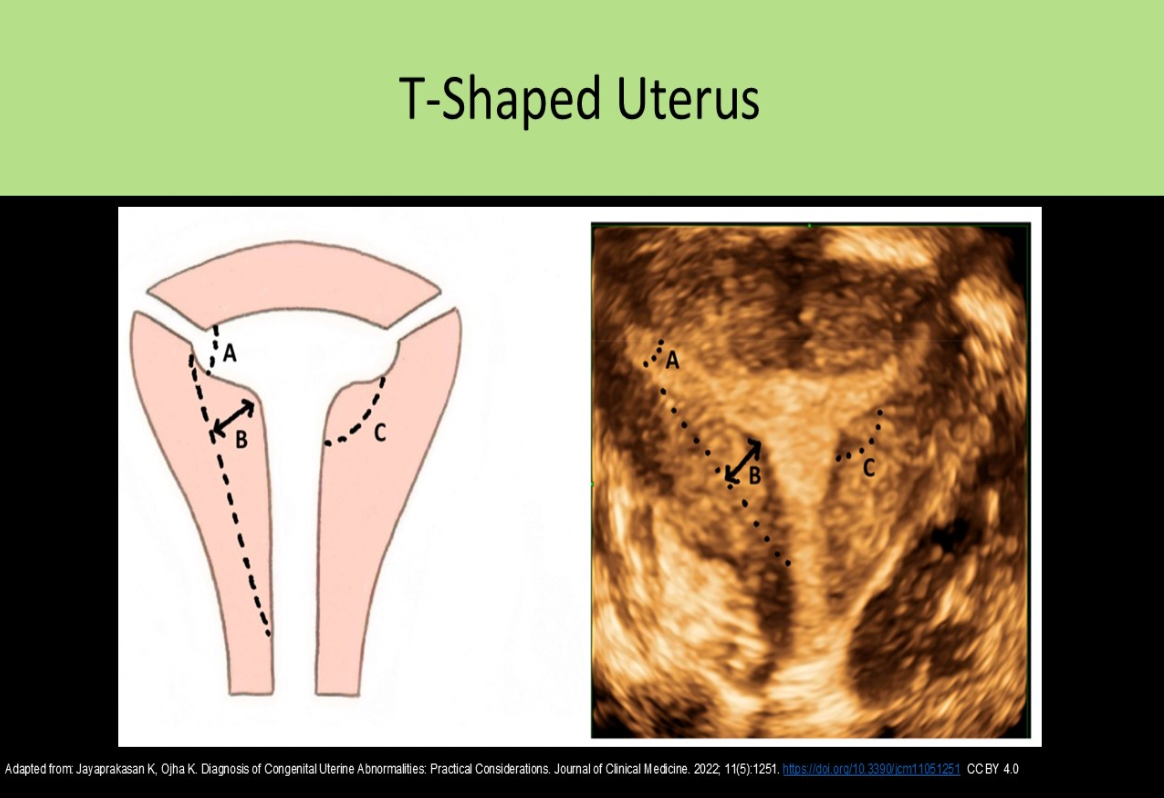<p>C. maternal exposure to diethylstilbestrol</p><p>Women took diethylstilbestrol to prevent spontaneous abortion 1940 - 1960. Daughters of these women have demonstrated uterine anomalies including a T-shaped uterus.</p>