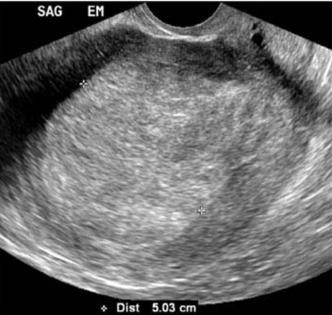 <p><span>A 58 year old woman, history of breast cancer, presented with abnormal uterine bleeding. She has been postmenopausal for 6 years. What pathology could this be?</span></p>