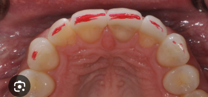 <p>Towards the cutting edge of the anterior teeth — opposite of apex of tooth</p>