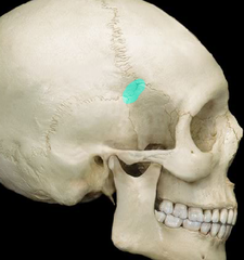 <p>H-shaped junction of the frontal, parietal, temporal, and sphenoid bones</p>