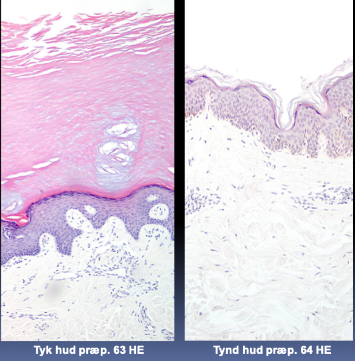 <p>Tyk hud har meget tykkere <strong>epidermis</strong>, især stratum corneum.</p>