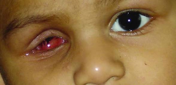 <p>Malformación congénita grave y poco frecuente caracterizada por la ausencia total de uno o ambos globos oculares en la cavidad orbitaria.</p>