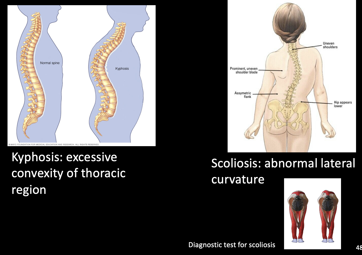 <p>-<span>Kyphosis: excessive convexity of thoracic region</span></p><p><span>-Scoliosis: abnormal lateral curvature</span></p><p><span>*often accompany each other</span></p><p><span>-(Hyper)lordosis AKA āpelvic tiltā: increased lordotic curve, if pregnant or obese</span></p>