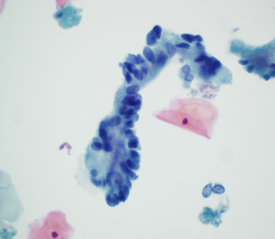 <p>35F pap smear - the finding is best classified as what</p>