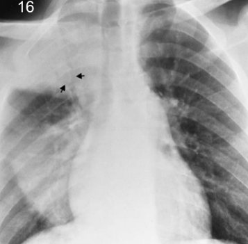 <p>Homogenous consolidation of right lung with associated bronchograms. Bacterial. Inflammatory condition</p>
