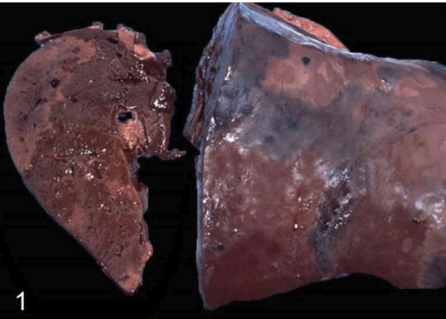 <ul><li><p>Spores are ingested and carried to liver</p></li><li><p>Migrating liver fluke causes tissue destruction → anaerobic conditions → pathogen proliferates</p></li><li><p>Produces <span style="color: green;"><strong>alpha-toxin</strong></span><strong> → </strong>local liver necrosis and damage to vascular system</p></li></ul><p></p>
