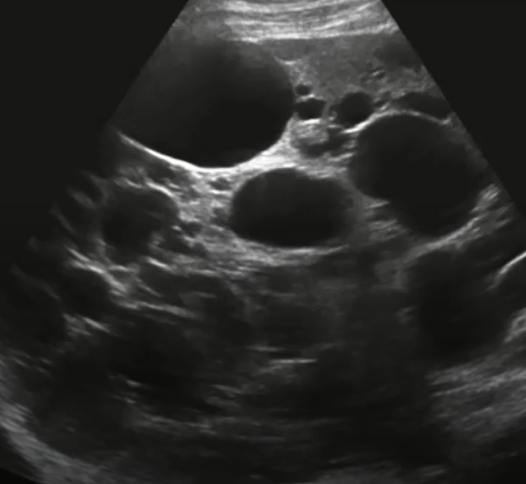 <p>___% of patients with autosomal dominant polycystic kidney disease will also have ___ ___</p>