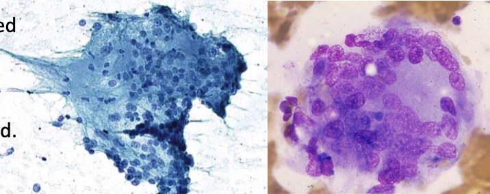 <p>1) Diagnostic cytologique bethesda</p><p>2) Diagnostic </p>