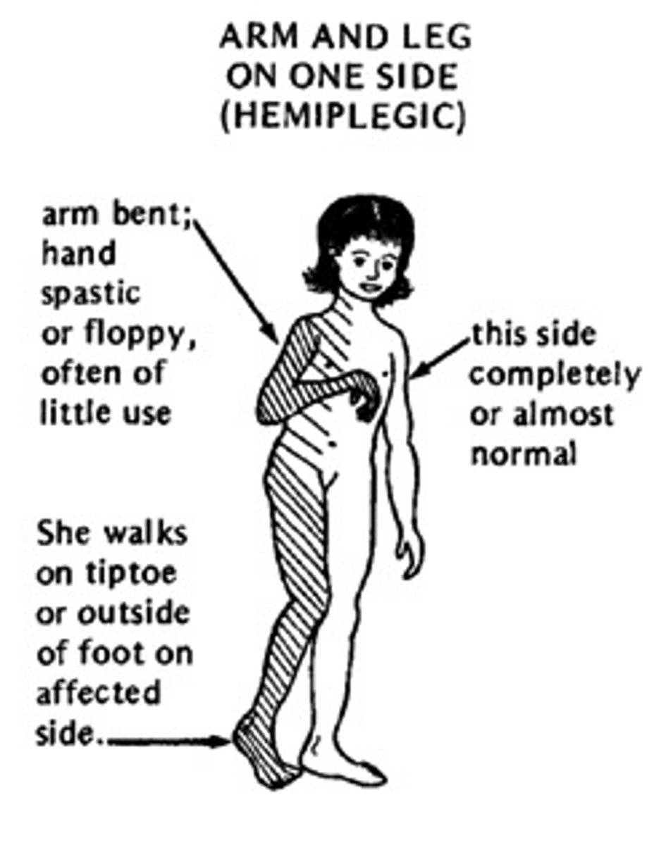 <p>spastic hemiparesis (see photo), parkinson's, foot drop</p>