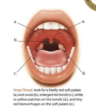 <p><span>Beefy red soft palate and uvula</span></p><p><span>enlarged red tonsils</span></p><p><span>white or yellow patches on the tonsils</span></p><p><span>tiny red haemorrhages on the soft palate</span></p>