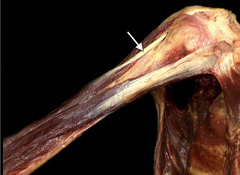 <p>In this anterior view of the right arm, identify the muscle indicated by the arrow.</p>