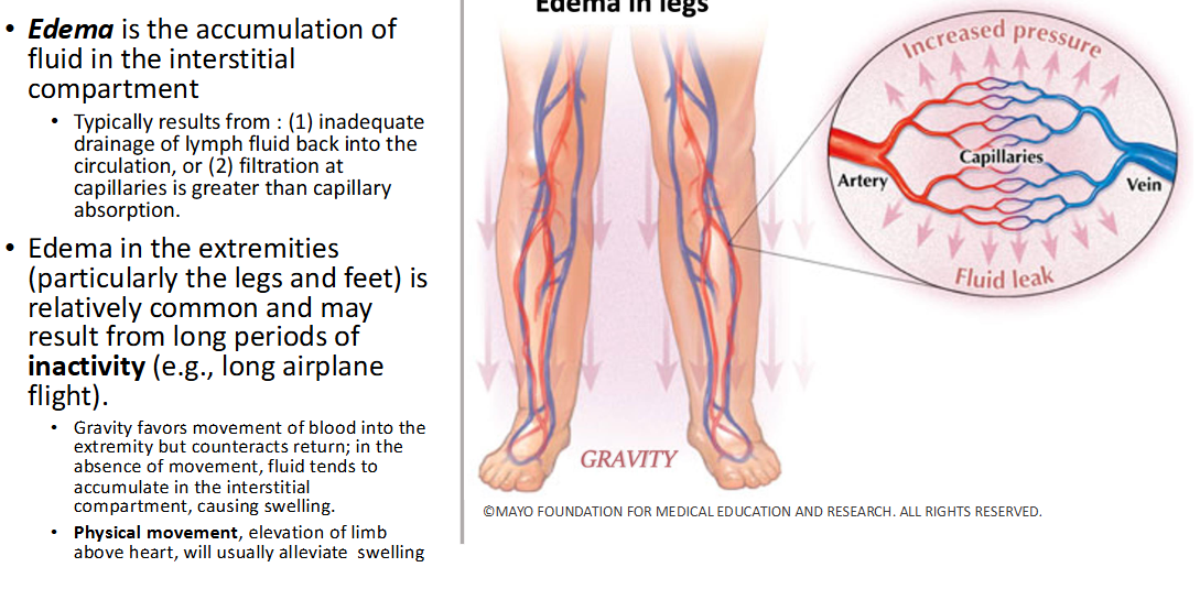 <p>accumulation of fluid in interstitial compartment (between cells rather than in circulatory/lymphatic)</p>
