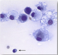 <p>a common joint disease that is consistent with this cytology</p>