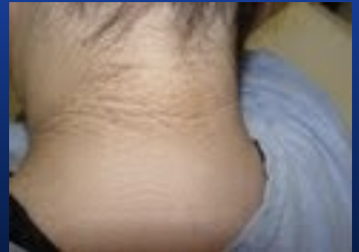 <p>Nonspecific skin reaction associated with obesity, endocrine syndromes, malignancies, and inherited disorders.</p>
