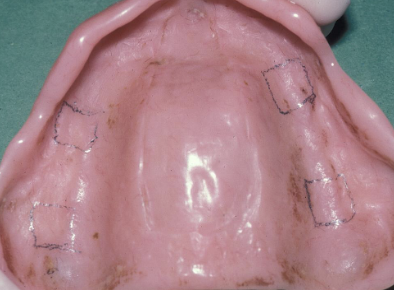 <p>How do you take the final impression for the reline or rebase?</p>