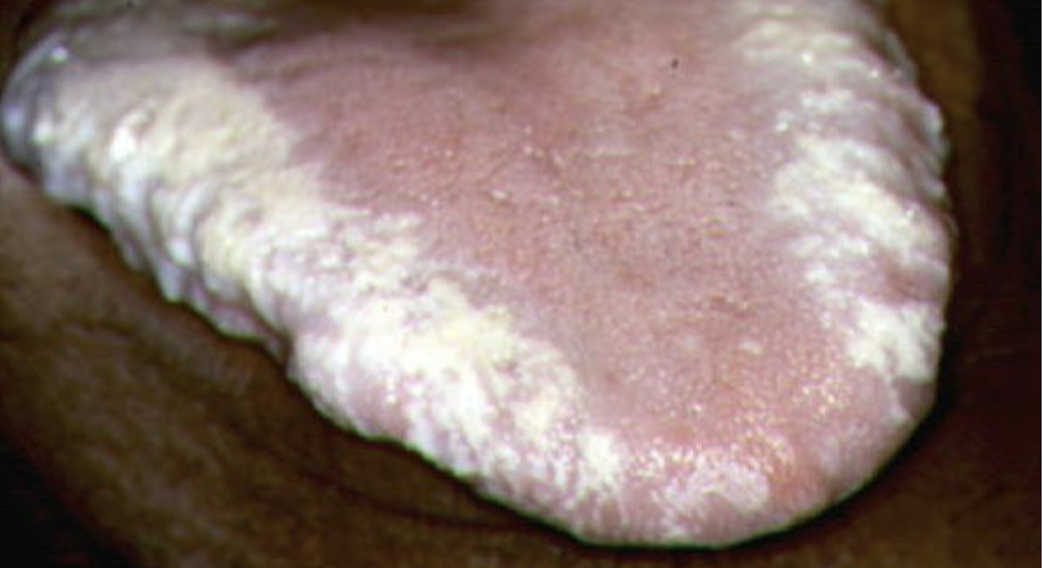 <p>what is this lesion called and what virus is it associated with</p>