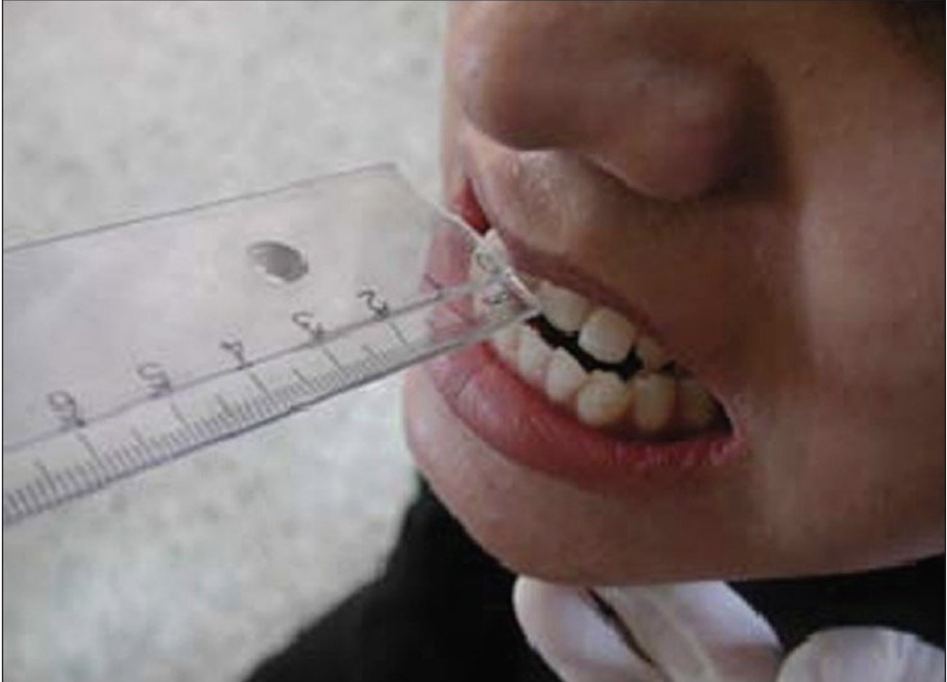 <p>• Protrusion is typically 8-12 mm </p><p>• Retrusion is about 3 mm (from neutral) </p><p>• measurement taken from the incisal edges (biting surfaces) of the front teeth.</p>