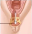 <p>Perineal laceration involving the anal sphincter complex</p><p>-Requires absorbable sutures and single dose of cefoxitin</p>