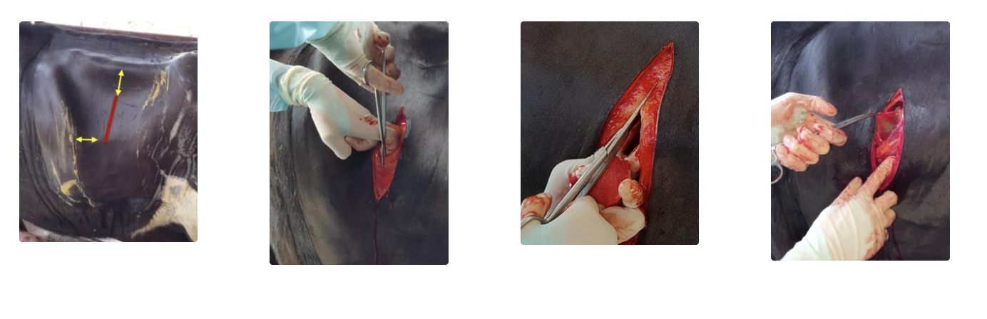 <p><strong>SKIN</strong></p><ul><li><p><u>Location:</u> 4 - 5 fingers below transverse processes and 4 - 5 fingers caudal to last rib</p><ul><li><p>Too high → Retroperitoneal</p></li><li><p>Too low → Viscera prolapses through incision</p></li></ul></li><li><p><u>Size:</u> Depends on indications (must be able to pass at least arm)</p><ul><li><p>Skin cut = LONGEST</p></li></ul></li><li><p><u>Method:</u> Hold scalpel FLAT with index finger OR thumb over tip to protect cow from scalpel</p></li></ul><p></p><p><strong>MUSCLE</strong></p><ul><li><p><u>Layers:</u></p><ol><li><p>External abdominal oblique muscle = Thickest</p></li><li><p>Internal abdominal oblique muscle</p></li><li><p>Transverse abdominal muscle = Thinnest</p></li></ol></li><li><p><u>Methods:</u></p><ol><li><p><strong>Sharp approach</strong> = Cut straight through muscle layers</p><ul><li><p><u>+ve:</u> Easy and straight line to suture</p></li><li><p><u>-ve:</u> More bleeding, trauma and higher risk of injury to internal structures</p></li></ul></li><li><p><strong>Grid approach</strong> = Stretch muscle fibres in direction they run with fingers/blunt dissection</p><ul><li><p><u>+ve:</u> Little bleeding, good healing, minimal trauma and protection of internal organs</p></li><li><p><u>-ve:</u> Harder to suture and NOT suitable for C-section/larger manipulations</p></li></ul></li></ol></li></ul><p></p><p><strong>PERITONEUM</strong></p><ol><li><p>Form tent with clamps/forceps</p></li><li><p>Make small incision with scissors OR scalpel</p></li><li><p>Listen to air rush into abdomen (rule out pneumoperitoneum)</p></li><li><p>Standing animal: Wait a few seconds to allow internal organs to fall away from abdominal wall</p></li><li><p>Extend cut under finger protection</p></li></ol><p></p>
