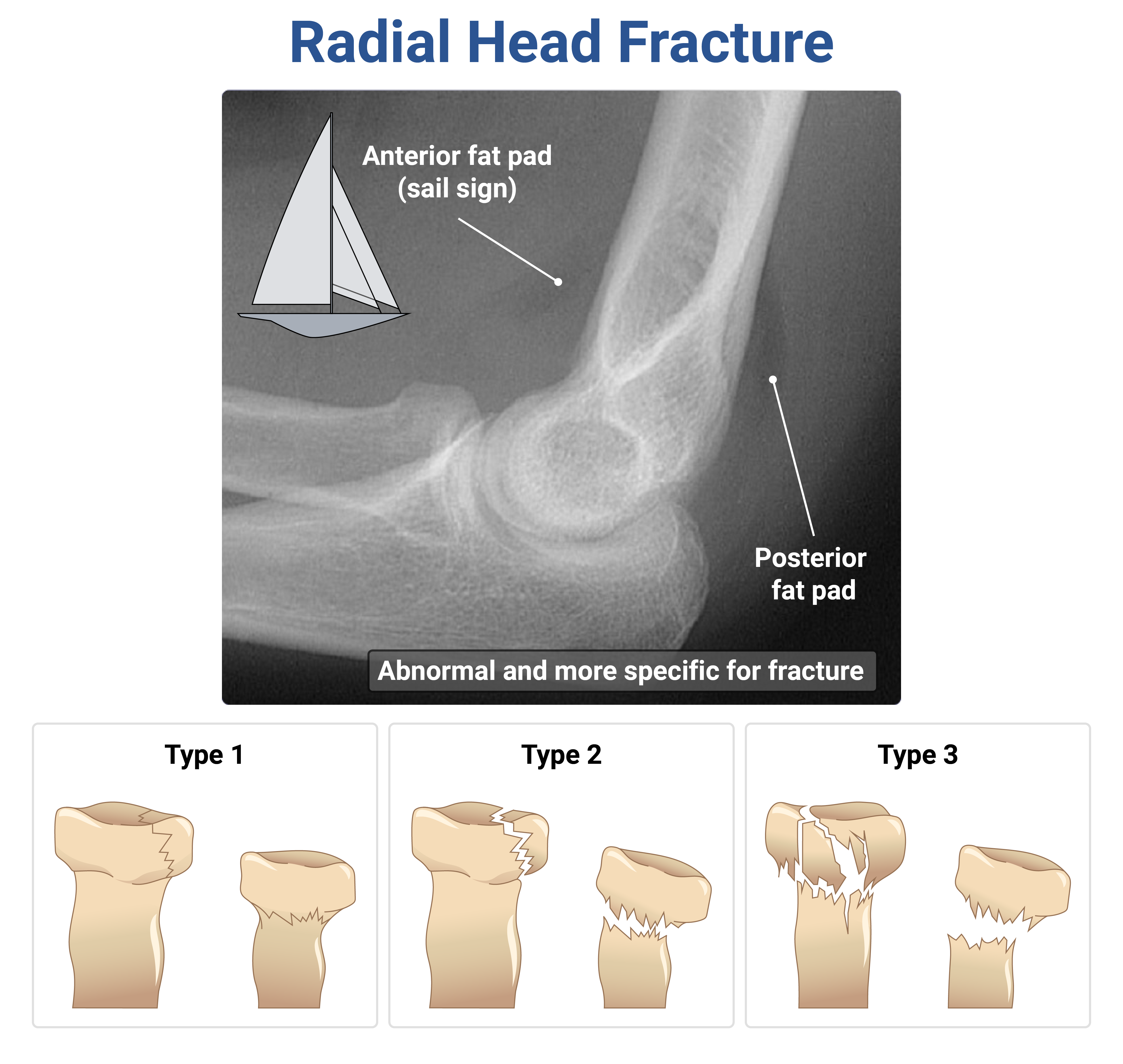 <p> ADULT with Radiographs of the elbow show an anterior and posterior fat pad but no obvious fracture or dislocation. What is the most likely diagnosis?</p>