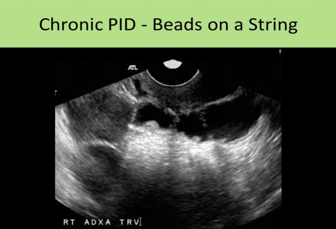 <p>B. beads on a string sign</p><p>Chronic PID: hydrosalpinx, thin-walled fallopian tube (<5mm)</p><p class="p1">Beads-on-a-String sign - remnants of the endosalpingeal folds demonstrate multiple 2-3mm nodules that project into the lumen</p><p class="p1">A peritoneal inclusion cyst may also be seen as a loculated fluid collection surrounding the uterus and ovaries.</p><p class="p1">Hydrosalpinx and pyosalpinx are differentiated from pelvic veins using color Doppler.</p><p class="p1">Hydrosalpinx and pyosalpinx are differentiated from bowel loops by visualizing peristalsis within the bowel.</p>