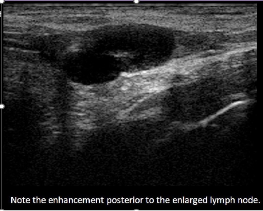 <p>C. Abnormal lymph nodes exhibit posterior enhancement.</p><p>Normal lymph nodes do not exhibit posterior enhancement. They are composed of mainly fatty tissue and lymphatic tissue which absorb and scatter sound. Abnormal lymph nodes do exhibit posterior enhancement due to the increased fluid within the inflamed tissues. The increased fluid within the tissues allows more sound to be transmitted through the node instead of reflected by the tissues. This leads to the enhancement of the reflection from the tissues posterior to the enlarged node. Lymph nodes larger than 1cm are considered suspicious and those over 2cm are considered abnormally enlarged.</p>