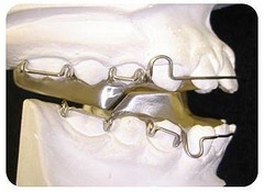 <p>what appliance for phase 1 treatment of class 2:</p><p>- Two piece appliance</p><p>- Looks like a Hawley retainer with occlusal coverage</p><p>- Bite ramp system</p><p>- Bite blocks prevents patient from biting in Class II occlusion</p><p>- Bite ramp encourages patient to bite in a more protrusive position</p>