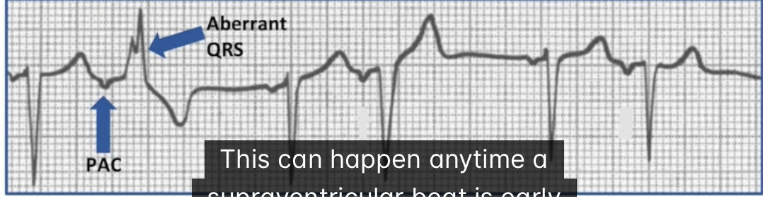 <ul><li><p>Abnormal intraventricular conduction of a supraventricular impulse</p></li><li><p>One or more components of distal conduction system refractory when impulse arrives</p><ul><li><p>Different conduction pathway</p></li><li><p>Any supraventricular impulse that is early enough</p></li></ul></li></ul><p></p>