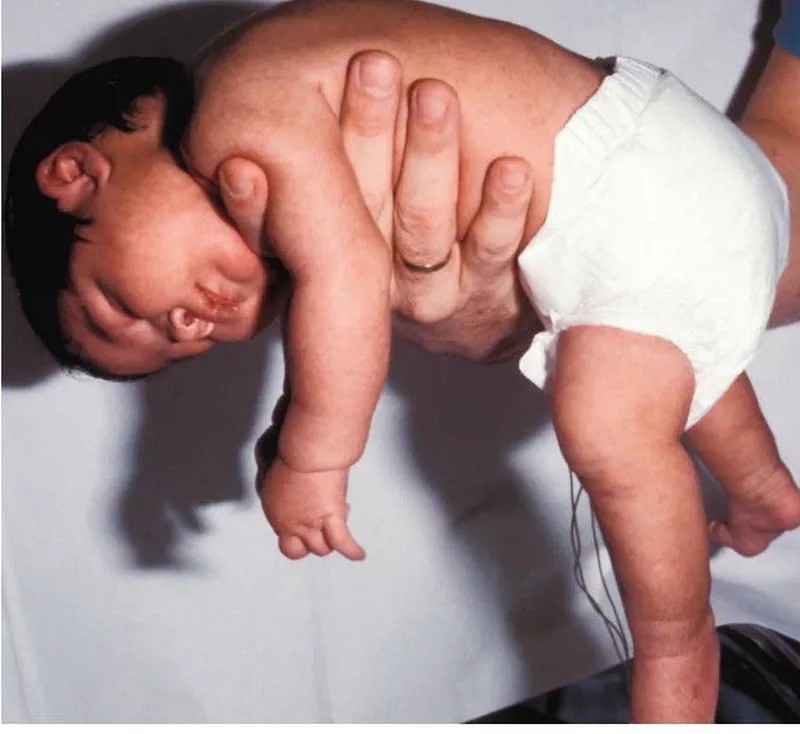 <p>Infant botulism</p>