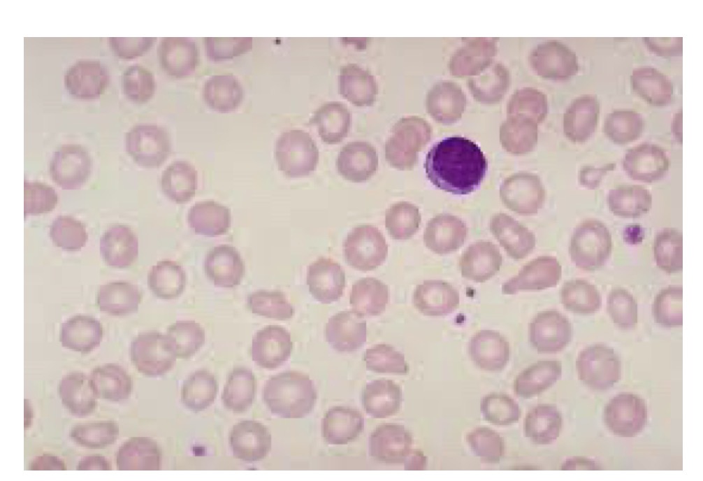 <p>What is iron deficiency anemia (IDA) </p>