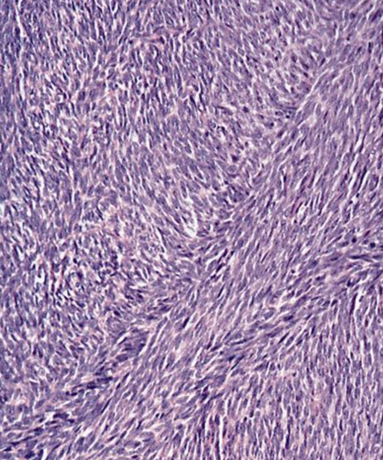 <p>tumeur de l’humérus, homme de 60 ans </p><p>diagnostic</p><p>définition</p><p>age</p><p>anatomie</p><p>histologie</p><p>moléculaire</p><p></p>